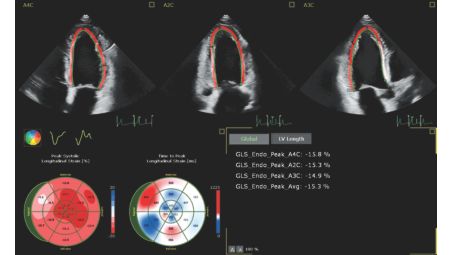 Automation for robust, proven reproducible cardiac quantification in both 2D and 3D