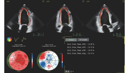 自动化功能助力您在二维和三维成像中，均能实现可靠且高重复性的心脏量化参数