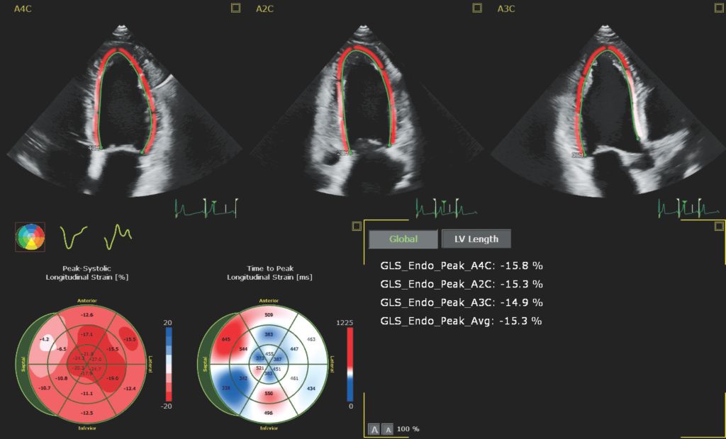 Dynamic Heartmodel
