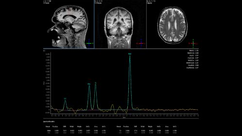 Spectroscopy Brain MR Clinical application | Philips Healthcare