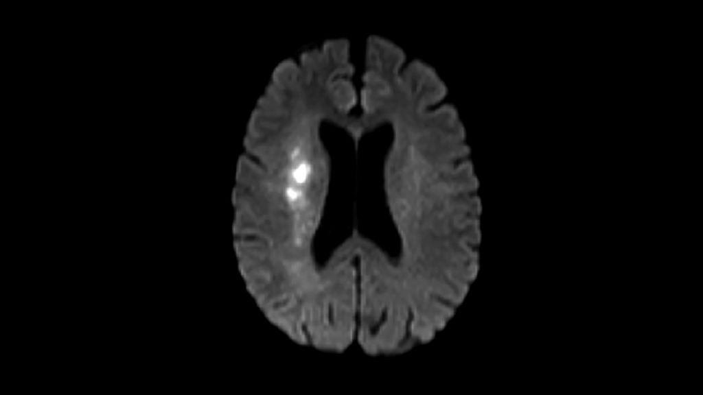 Diffusion  (b1000)