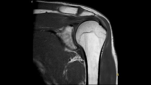 T1w - Shoulder