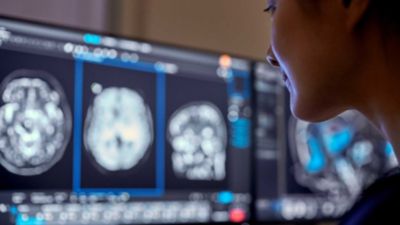 필립스 영상진단 워크스테이션에서 뇌 MRI 영상을 분석하는 의료진