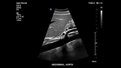 Abdominal aorta