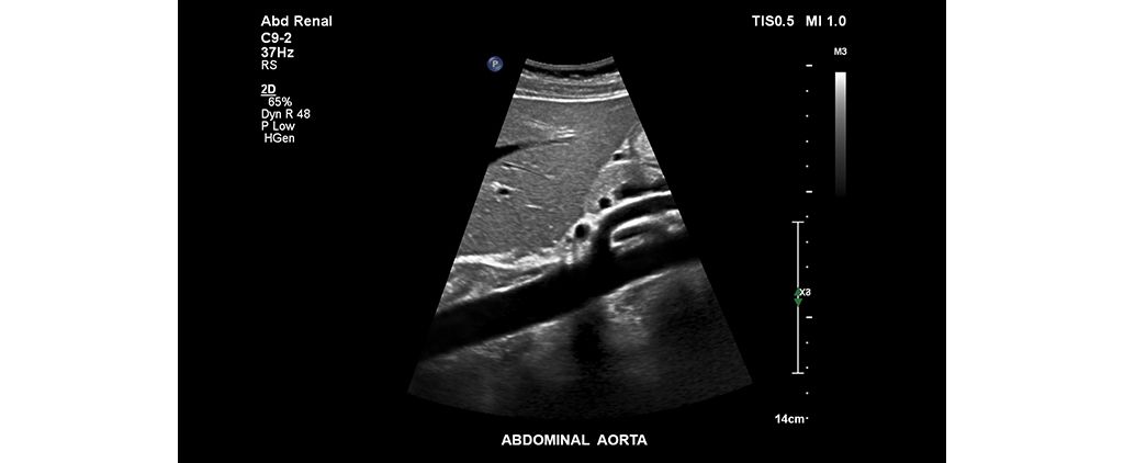 Abdominal aorta