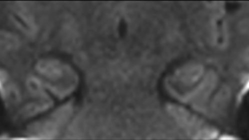 Coronal dS Zoom DWI (b1000)
