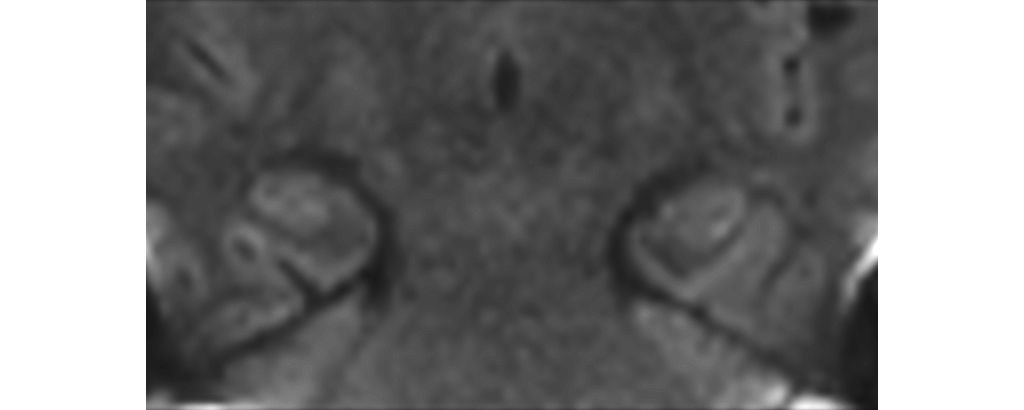 Coronal dS Zoom DWI (b1000)
