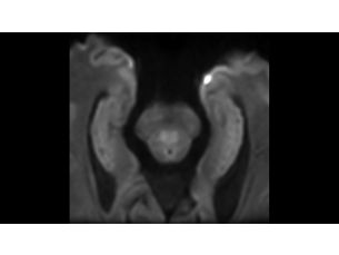 Zoom Diffusion - Brain MR clinical application