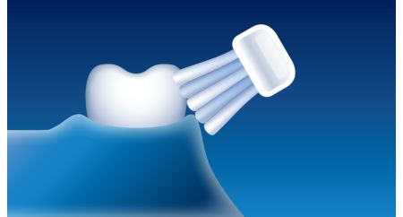 Plus performante qu'une brosse à dents manuelle pour la gingivite