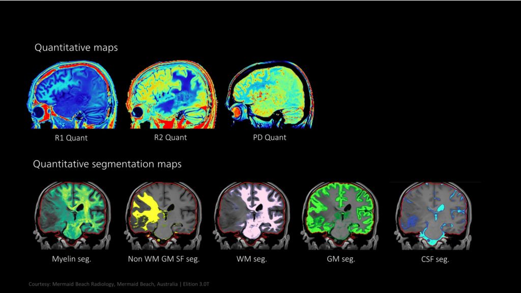 Quantitative maps and quantitative segmentation maps