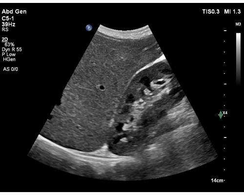 Ultrasound Web Gen Liver Kidney 2D