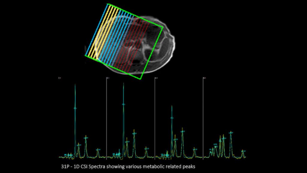 P140 Liver 1D CSI