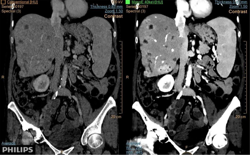Liver Mets