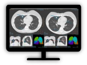 CT Lung Nodule Assessment Assess lung nodules over time