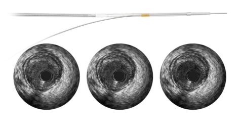 Revolution 45 MHz rotational IVUS imaging catheter