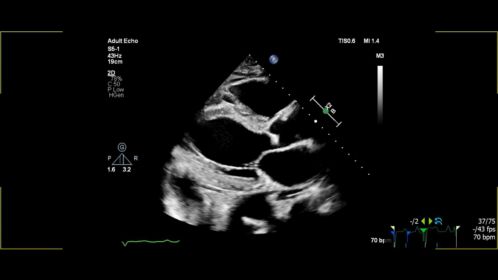 S5-1 transducer PLAX with Image Boost​