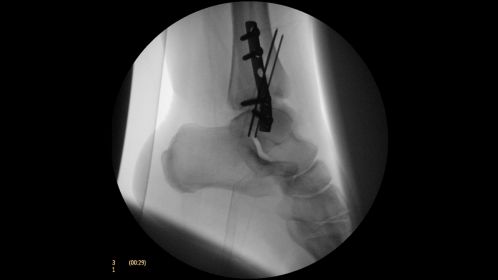 Clinical Image Philips BV Mobile C-arm Pulsera