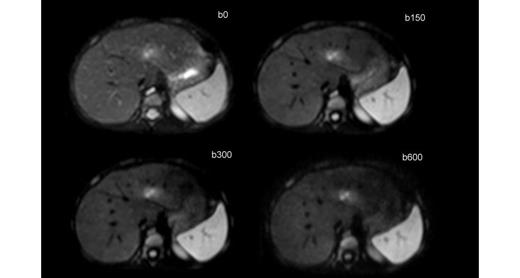 Axial Diffusion (Pediatric patient, respiratory triggered)