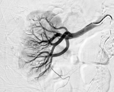 Angiogram toont geen angiografisch doelwitlaesie voor embolisatie.