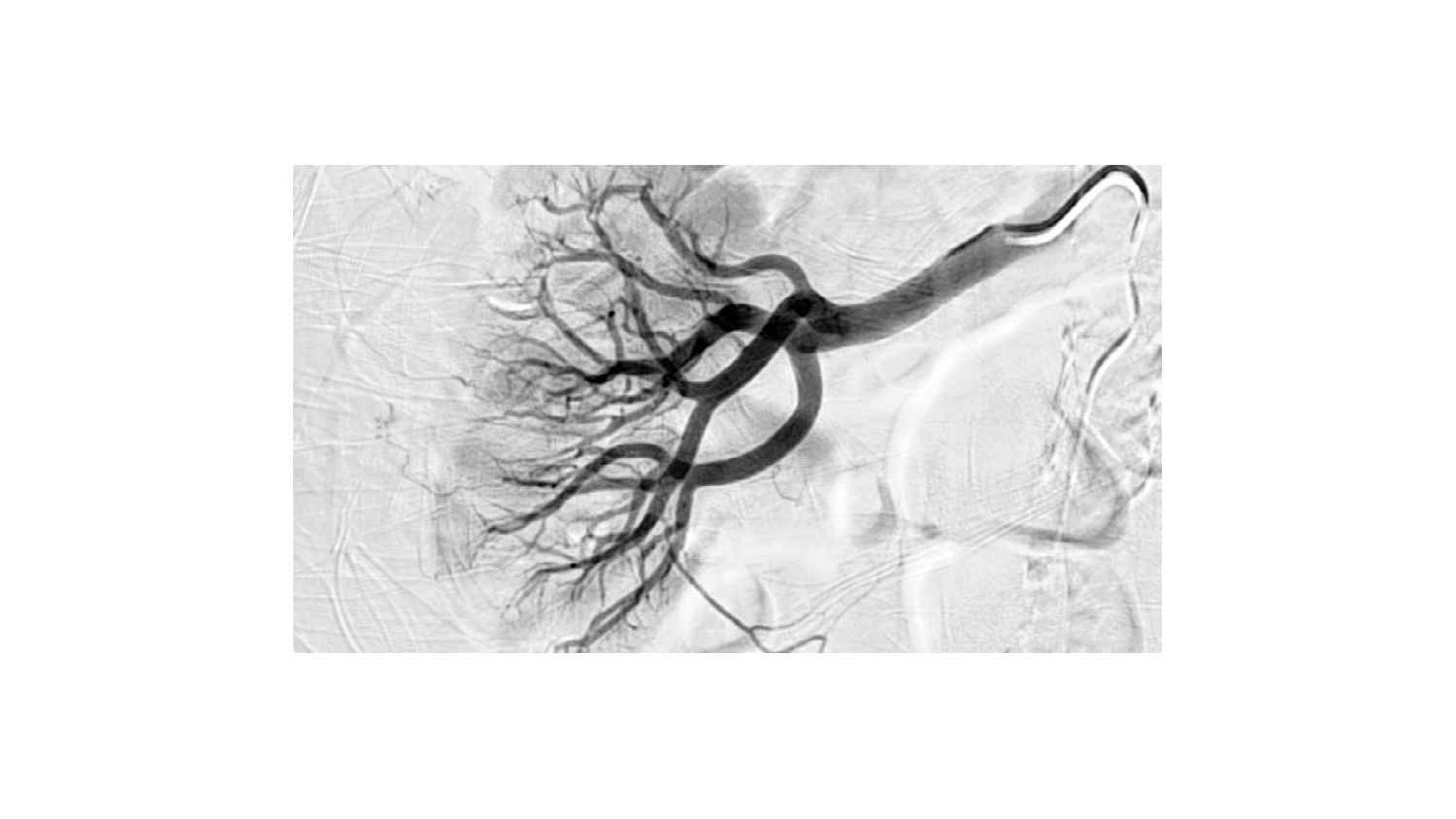 Angiogram showing no angiographic target lesion to embolize