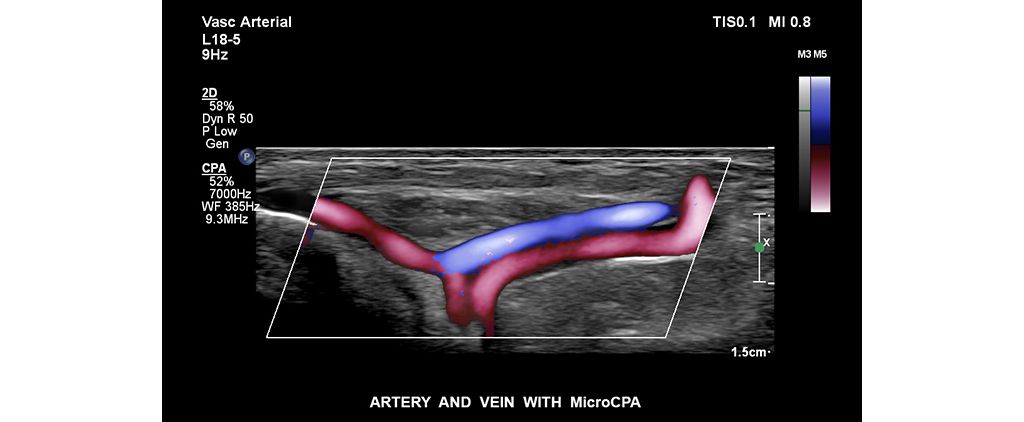 Artery and vein with MicroCPA