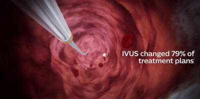 Philips Venous IVUS