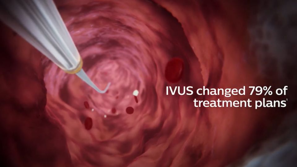 Philips Venous IVUS