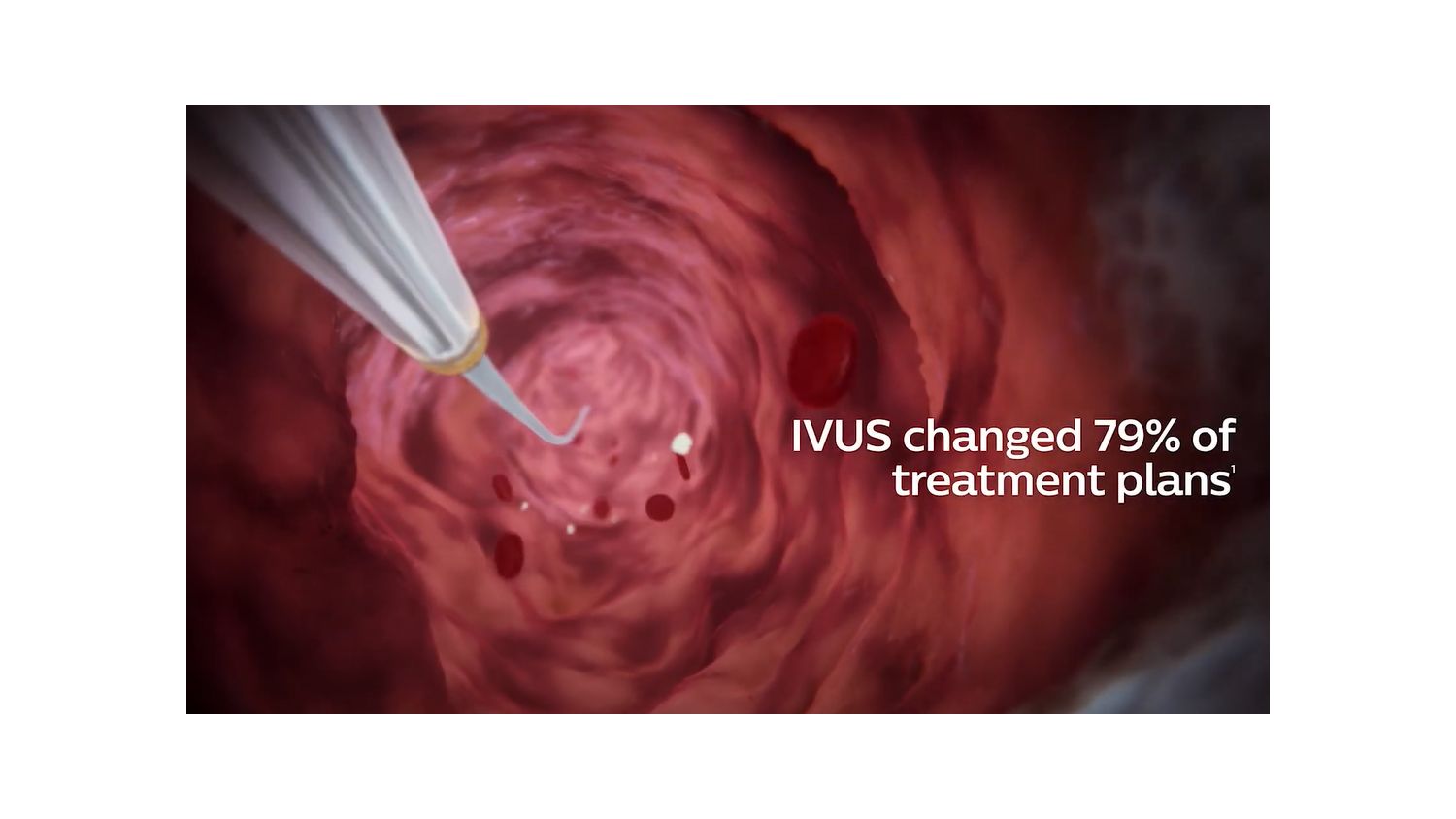 IVUS provides a 360-degree vessel view, detailing vessel sizing and plaque morphology with pinpoint accuracy, allowing you to select the optional treatment plan for your patients.