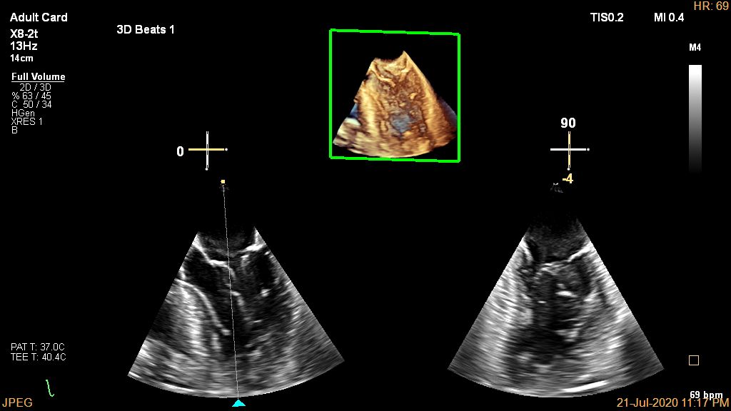 Live 3D TEE Left Ventrice CV Ultrasound Imaging