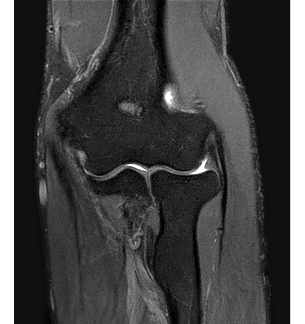 Coronal PDw SPAIR - Elbow