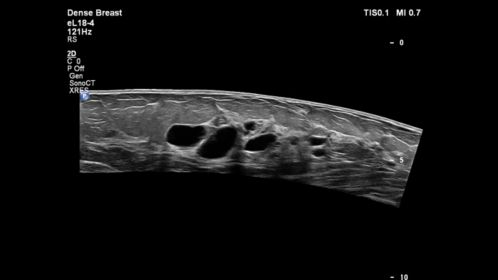 Multiple breast cysts with eL18-4 transducer dense breast preset