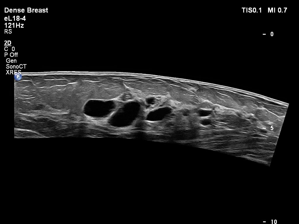 Multiple breast cysts with eL18-4 transducer dense breast preset
