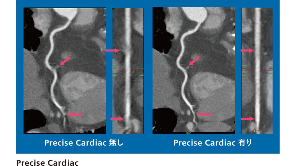 Precise Cardiac