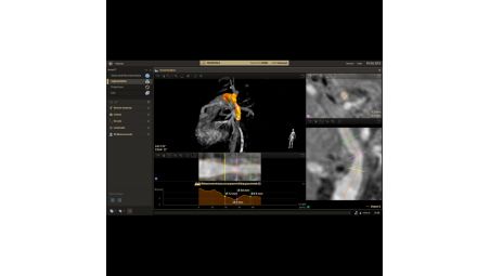 SmartCT Vessel Analysis supports treatment planning​