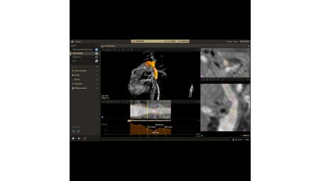 SmartCT Vessel Analysis respalda la planificación del tratamiento