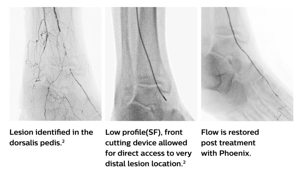 Low-profile system for distal lesion vessel access ³,⁵,⁶