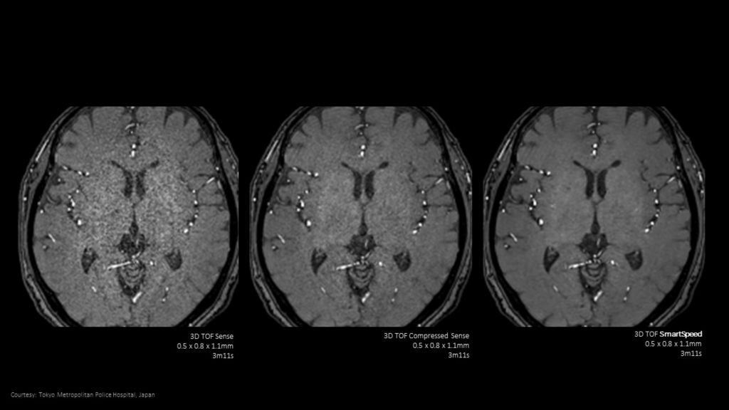 SmartSpeed - Brain