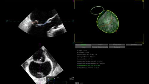Ultrasound Workspace 3D Auto MV