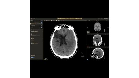 Early- and late-phase contrast- enhanced CBCT to visualize large vessel occlusion