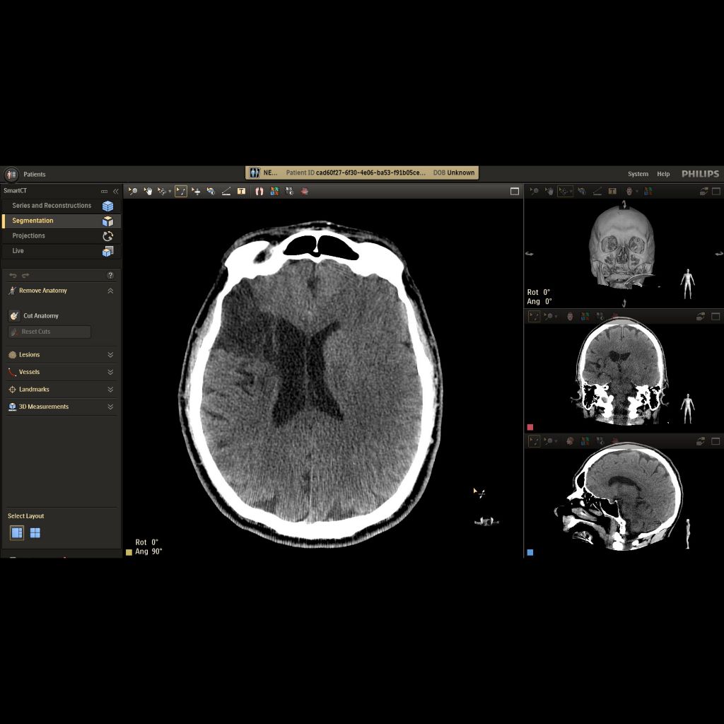 Early- and late-phase contrast- enhanced CBCT to visualize large vessel occlusion