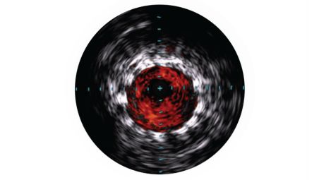 IVUS helps confirm treatment results