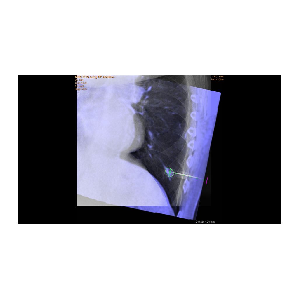 Achieve accurate needle placement