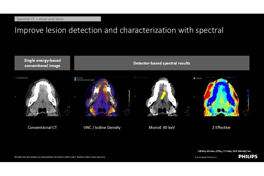 Spectral CT – Head and Neck