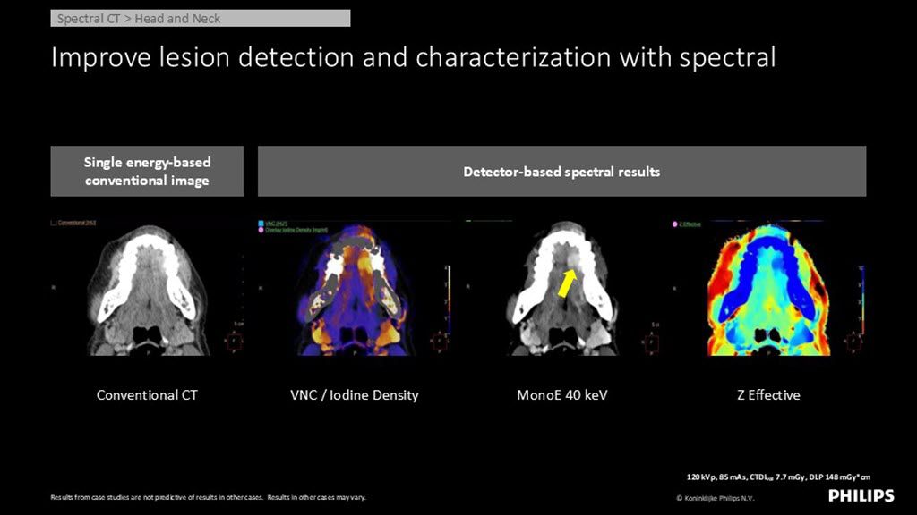 Spectral CT – Head and Neck