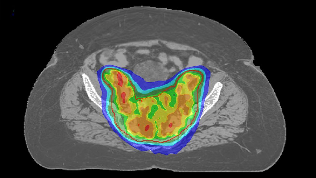MRCAT-based dose plan