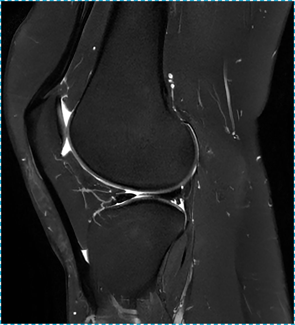 Knee  Sag T2 SPAIR