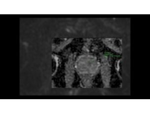 SmartSpeed Diffusion -  Pelvis Aplicaciones clínicas para RM