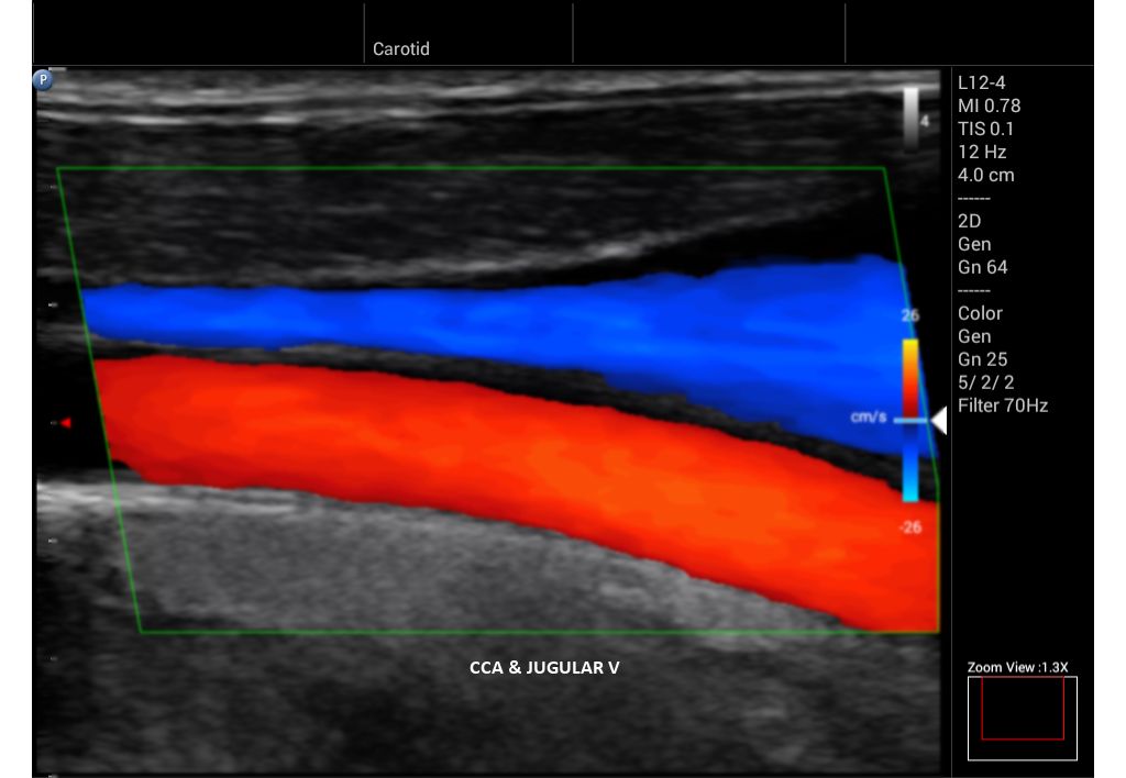 Innosight clinical image CCA and jugular