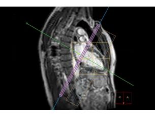 CardiacQuant Perfusion Motion-robust myocardial perfusion imaging for quantitative insights