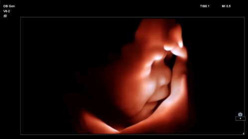 Affiniti 30 ultrasound clinical image truevue V6-2